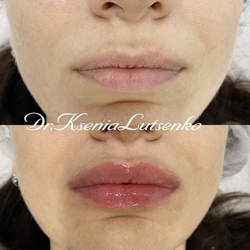 Увеличение губ,  косметолог Ксения Луценко 1670821