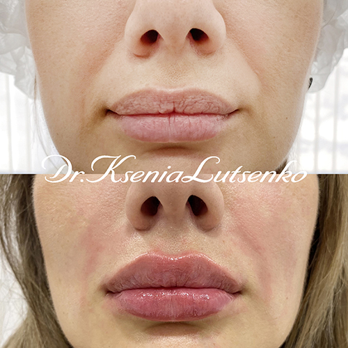 Увеличение губ, устранение носогубных морщин,  косметолог Ксения Луценко 160821  